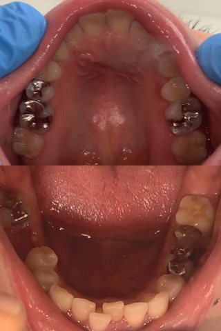 【歯医者行き当確♡】さくらの右下奥歯に虫歯注意報‼ドライソケット状態の歯茎に挟まる異物