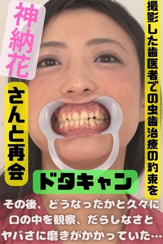 【エグい虫歯＆銀歯】実は虫歯治療を放棄したカノハナさんの危険すぎた口内‼