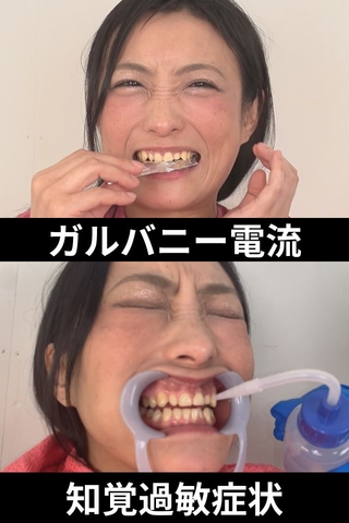 【エグい虫歯＆銀歯】実は虫歯治療を放棄したカノハナさんの危険すぎた口内‼
