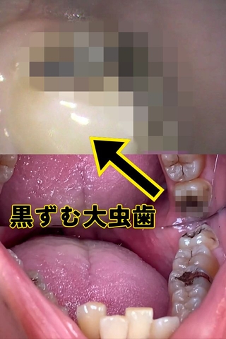 奥歯崩壊⁉即歯医者行き案件‼【虫歯３本以上…《銀歯治療確定》】栗山さつきの放置された口内鑑賞