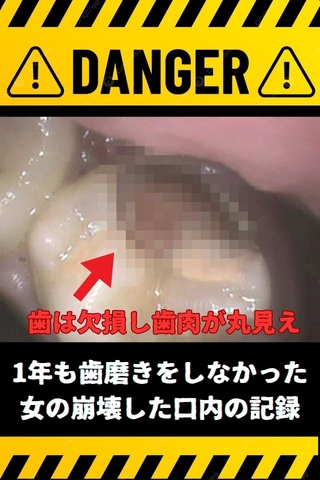 【Xにて応募してきた素人モデルあかりさん（２７）】虫歯4本以上‼崩壊歯も多数アリ！銀歯治療を希望の訳あり口内