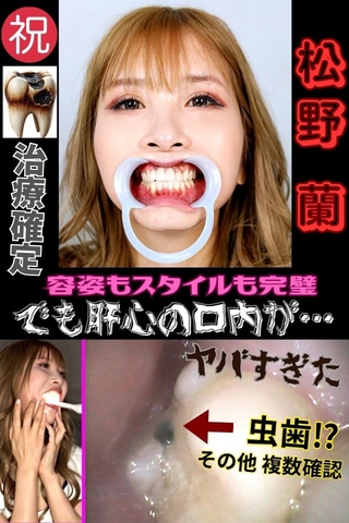 【歯医者案件】ビューティーLady 松野蘭に即歯医者連行の大虫歯発見⁉～卑猥にくねるベロ接吻、そして爆音ゲップ！