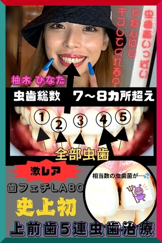 【歯フェチLABO史上初】前代未聞の前歯全虫歯‼5箇所50分ノンストップ大掘削で歯闘を繰り広げるGALひなた