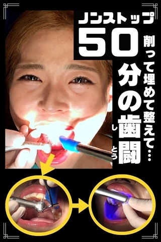 【歯フェチLABO史上初】前代未聞の前歯全虫歯‼5箇所50分ノンストップ大掘削で歯闘を繰り広げるGALひなた