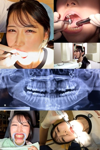 【銀歯確定⁉の大虫歯発見】怖がり痛がり、りおちゃんの右下３連掘削治療