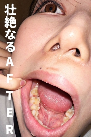 【銀歯確定⁉の大虫歯発見】怖がり痛がり、りおちゃんの右下３連掘削治療