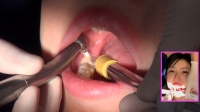 フェチ：【虫歯治療】仕事に忙殺されて長年間放置された口内…塩見彩ちゃんの右上下にタービン侵入‼