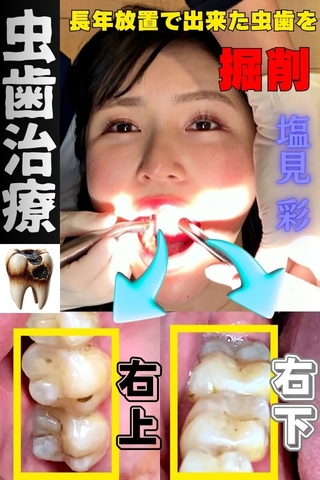 【虫歯治療】仕事に忙殺されて長年間放置された口内…塩見彩ちゃんの右上下にタービン侵入‼