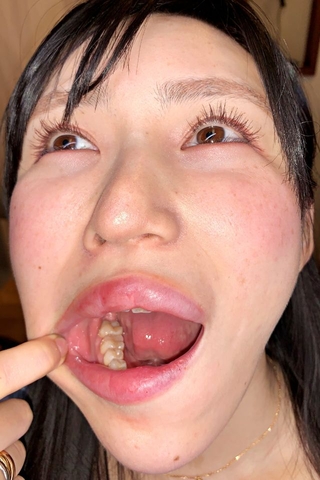 【虫歯治療】仕事に忙殺されて長年間放置された口内…塩見彩ちゃんの右上下にタービン侵入‼