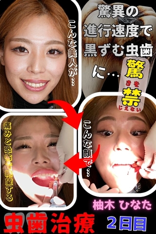 【虫歯治療２日目】嬉来には程遠い⁉たった数か月で真っ黒に進行した虫歯に奮闘する関西GALひなた♡