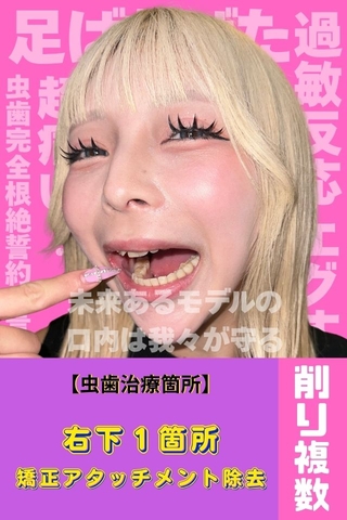 【虫歯治療】天然歯に刻まれた黒印‼ゆるふわましゅまろボディGAL鹿野あもちゃんの初虫歯治療