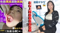 一見キレイな白い歯の彼女...【麻酔ナシ虫歯治療】